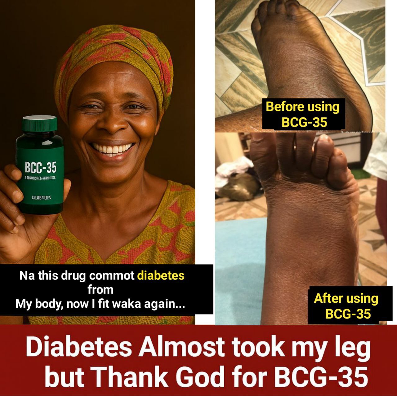 BCG-35